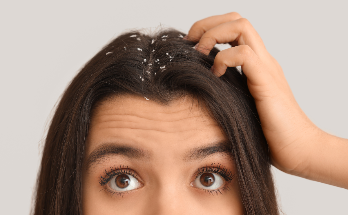 De ce revine mătreața