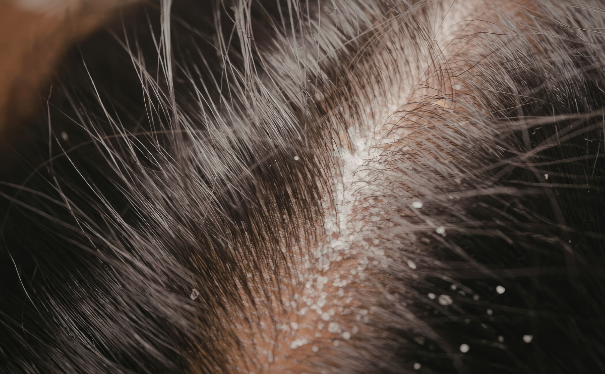 Mătreață grasă sau mătreață uscată